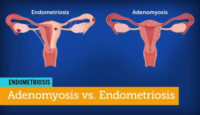 Yoniverse Pearl endometriosis/Adenomyosis  Kit